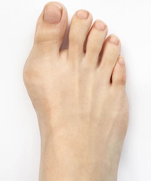 hallux valgus před použitím spreje Hondro Sol Valgus