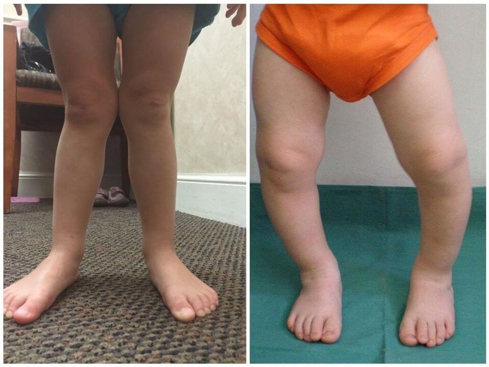 Deformace valgus u dětí způsobuje