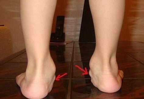 Valgus deformace nohou u dětí