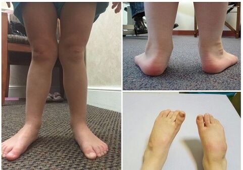 Deformace valgus u dětí