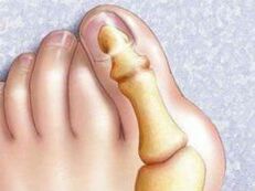 Deformita Hallux Valgus
