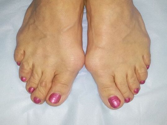Deformita hallux valgus nohou