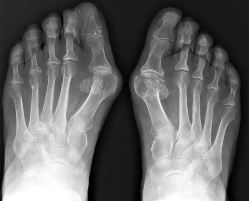 Rentgenový snímek hallux valgus